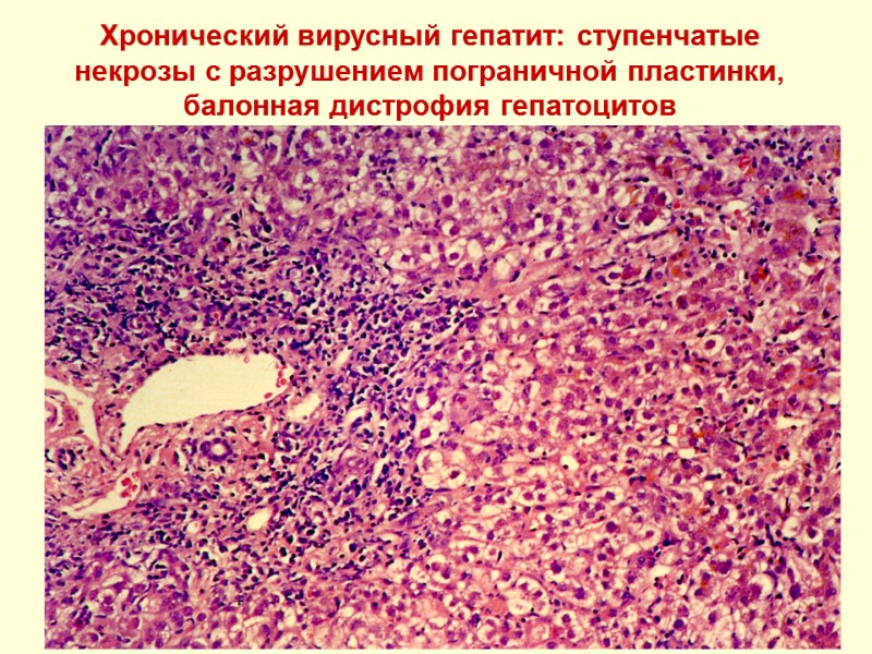 Хронический вирусный гепатит: ступенчатые некрозы с разрушением пограничной пластинки, балонная дистрофия гепатоцитов